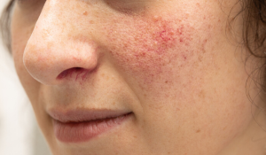 Rosacea Treatment
